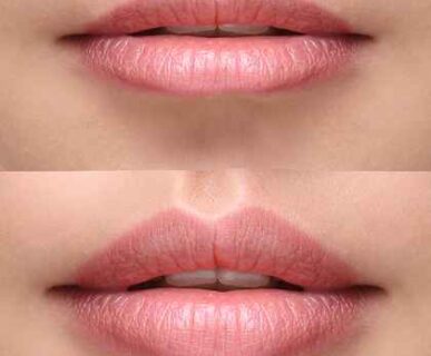 Natural-Lip-Filler-Before-After
